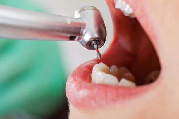 Best Emergency Dental Extractions in Mayo, FL